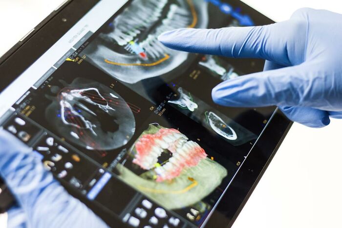 Medical professional wearing gloves pointing at detailed jaw X-ray images on a tablet related to surgery awareness cases.