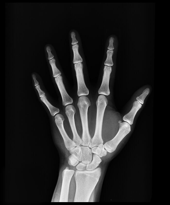 X-ray of a human hand showing extra bone structure, illustrating one of the most disturbing things about human bodies.