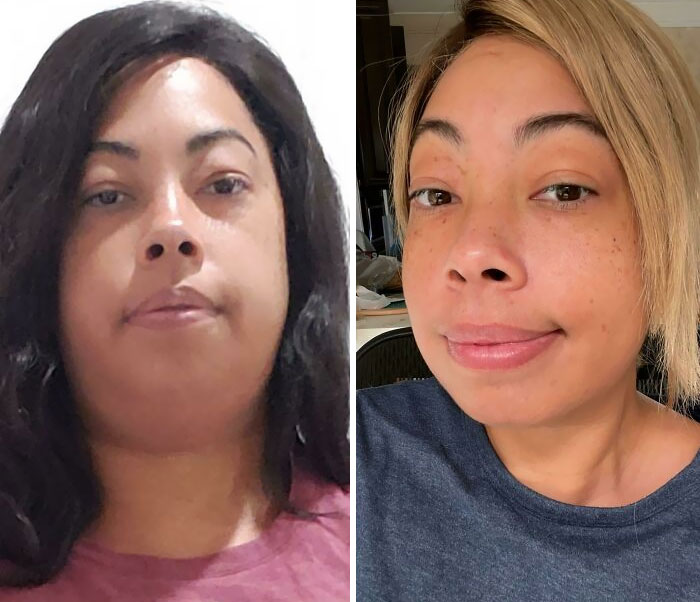 I Gained My Chin Back