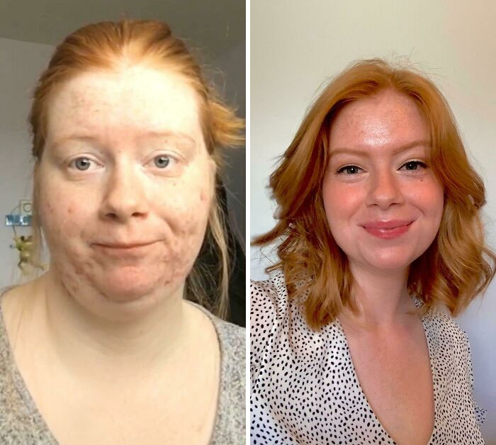 From 190 To 129 Lbs. I Used To Be Afraid Of Having Short Hair Because Of The Weight In My Face. Today, I Said Goodbye To The Old Me And Embraced My New Life