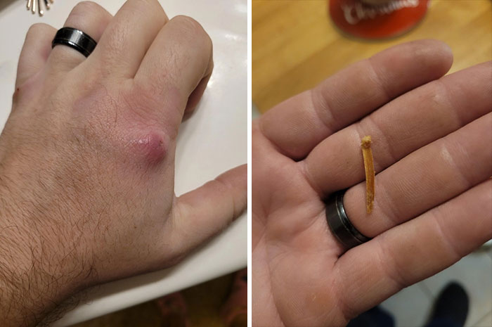 Thought I Had A Broken Knuckle For The Last 2.5 Years, Last Night This Splinter Popped Out