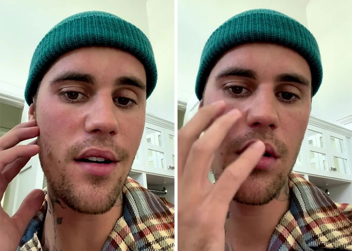 Justin Bieber Has Been Struck By Facial Paralysis, Leading To Ramsay Hunt Syndrome Diagnosis And Cancellation Of Shows Justin Bieber Has Been Struck By Facial Paralysis, Leading To Ramsay Hunt Syndrome Diagnosis And Cancellation Of Shows