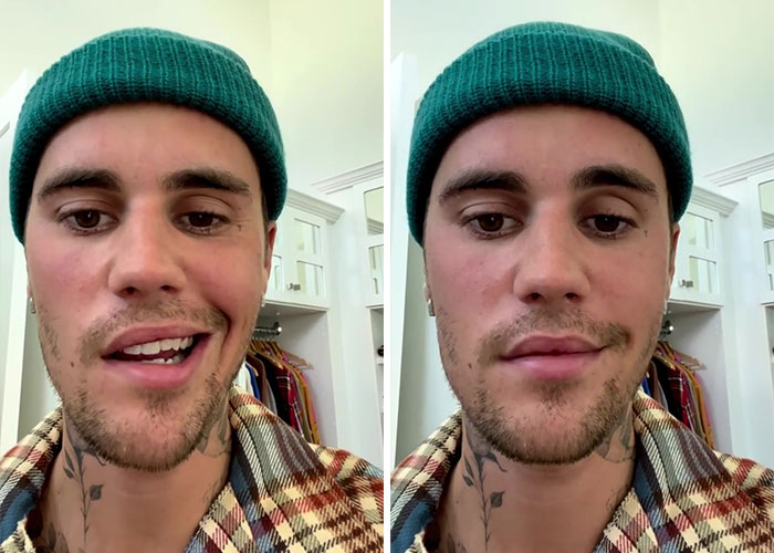 Justin Bieber Has Been Struck By Facial Paralysis, Leading To Ramsay Hunt Syndrome Diagnosis And Cancellation Of Shows Justin Bieber Has Been Struck By Facial Paralysis, Leading To Ramsay Hunt Syndrome Diagnosis And Cancellation Of Shows