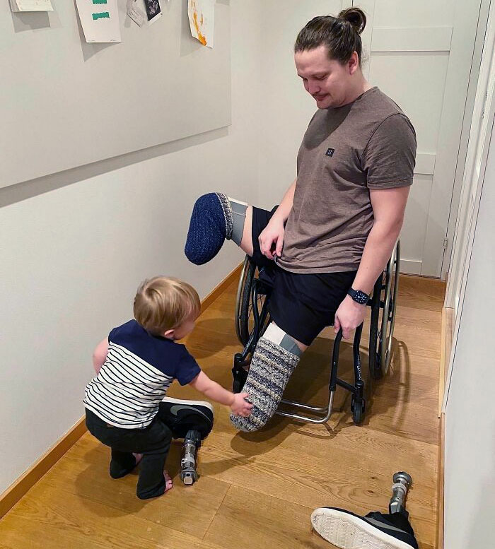 My Mother In Law Knitted Me These Fuzzy Stump Socks Over The Last Two Skiing Seasons. They Keep Me Warm During The Winter When I'm Not Using My Prosthetics