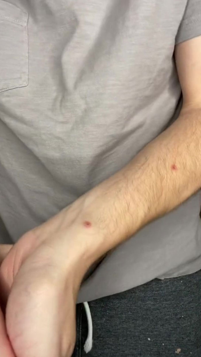 Monkeypox Is Starting To Spread More Widely And This Guy Shares What You Can Expect As He Went Through It Himself Monkeypox Is Starting To Spread More Widely And This Guy Shares What You Can Expect As He Went Through It Himself