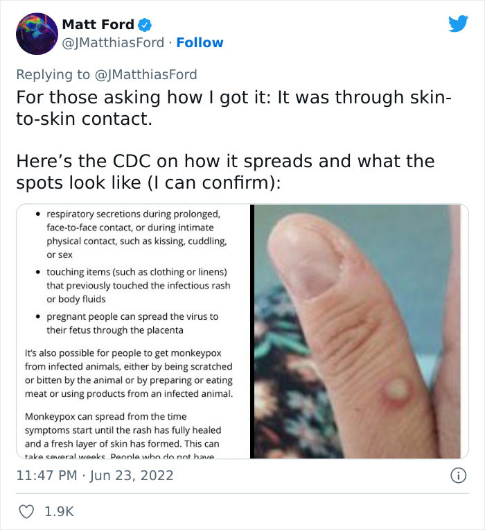 Monkeypox Is Starting To Spread More Widely And This Guy Shares What You Can Expect As He Went Through It Himself Monkeypox Is Starting To Spread More Widely And This Guy Shares What You Can Expect As He Went Through It Himself