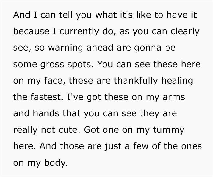 Monkeypox Is Starting To Spread More Widely And This Guy Shares What You Can Expect As He Went Through It Himself Monkeypox Is Starting To Spread More Widely And This Guy Shares What You Can Expect As He Went Through It Himself