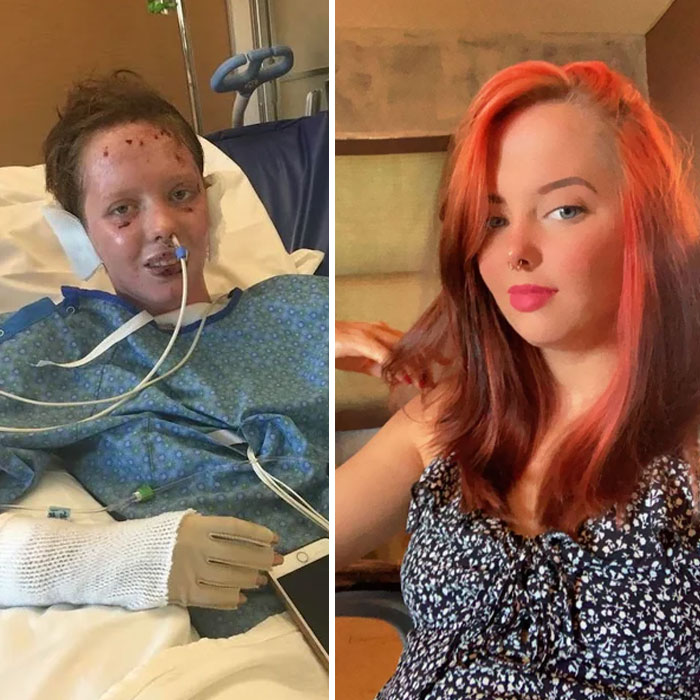 2.5 Year Difference. From Being Exploded To Thriving, I Didn’t Think I’d Make It Through The Physical And Mental Aspects Of Recovery. But, Here I Am