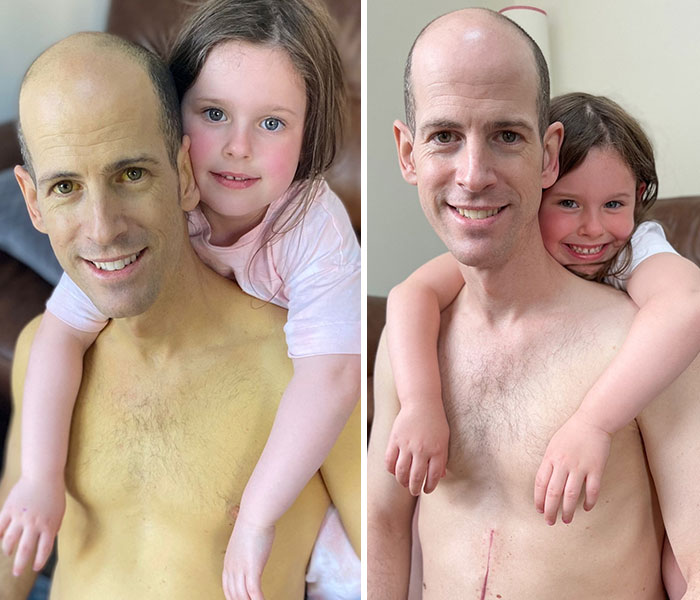 Dad Saved By Liver Transplant Shares Pictures Taken Before And After, Showing His Remarkable Recovery - 1