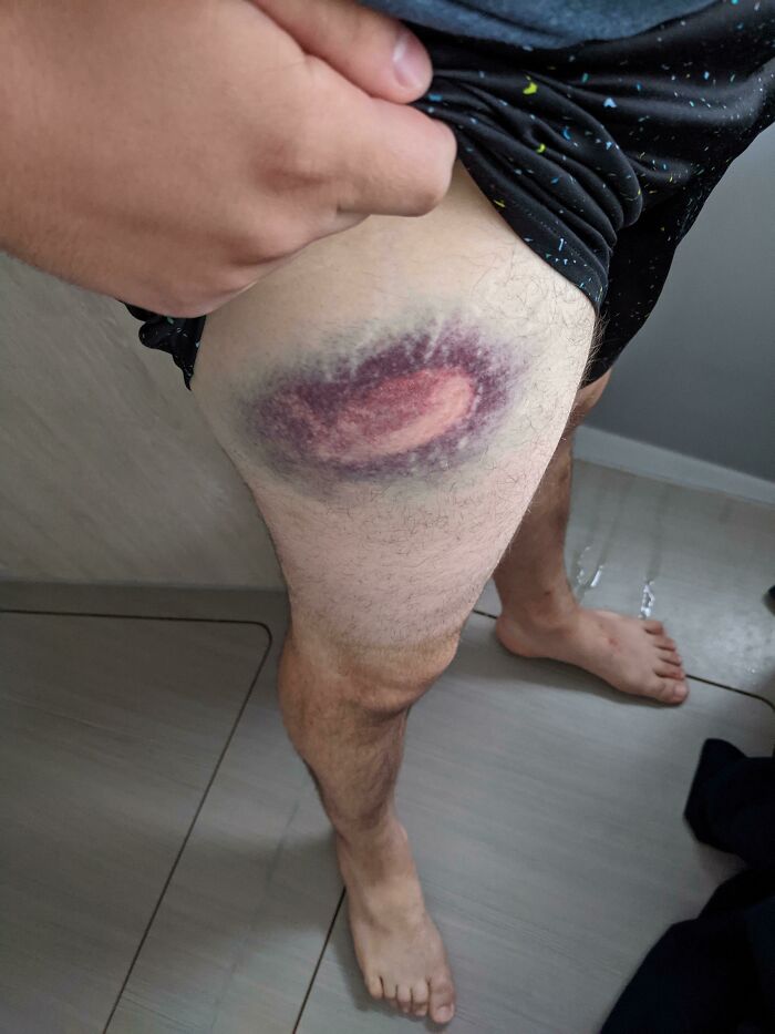 My Bruise Kinda Looks Like A Nebula In Space