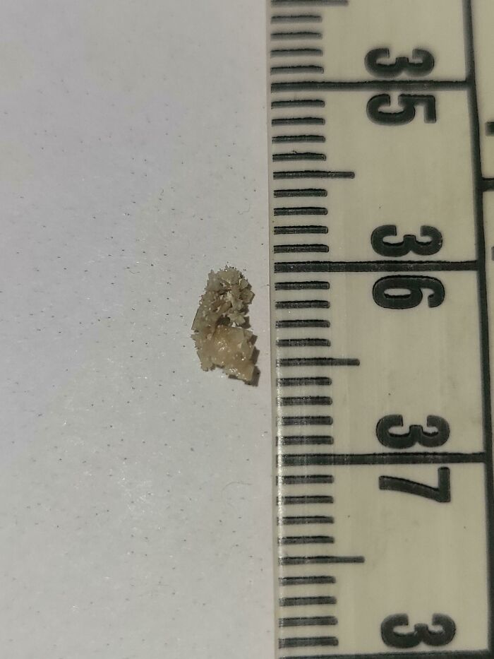 Mi marido tiene piedras en el riñón frecuentemente. Acaba de pasar esta