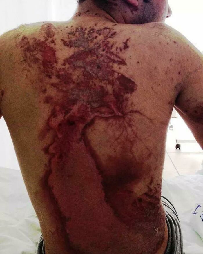 Lesiones tras la caida de un rayo, con figuras de Lichtenberg visibles