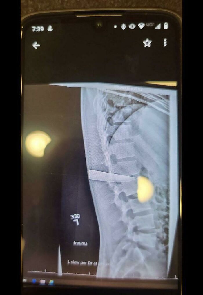 When A Nurse Lets You And Your Partner Know That The Patient You Transported A Month Ago Did Not Just Have A Small Cut On His Back 