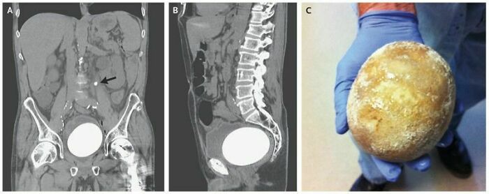 Piedra en una neovejiga