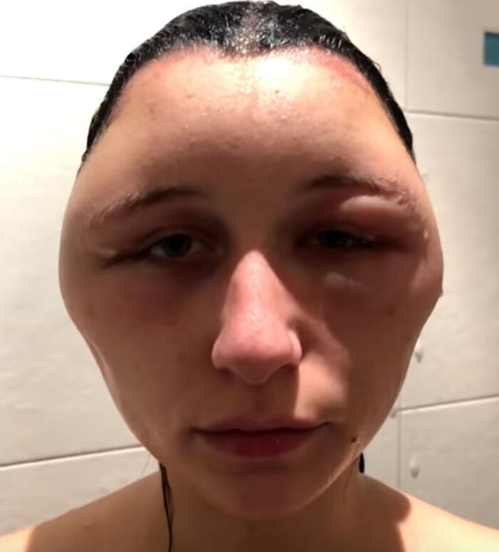 Hinchazón debida a reacción alérgica al tinte capilar