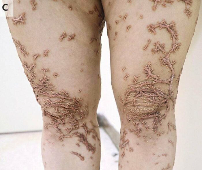 Caso extremo de xantoma eruptivo