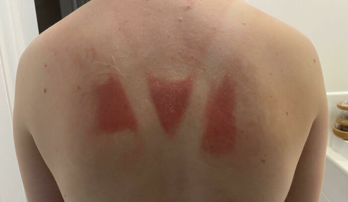 Reapplied Sunscreen Twice, Wore A Hat, Sat In The Shade, Even Had My Mother Help Me Reach Places I Couldn’t Get To. Yet This Still Looks Like I Walked Into Reactor 4 Of Chernobyl