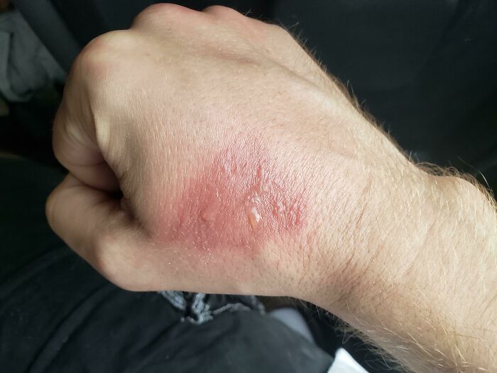 Fell Asleep On A Beach In Mexico, Woke Up With One Spot Of A Sunburn