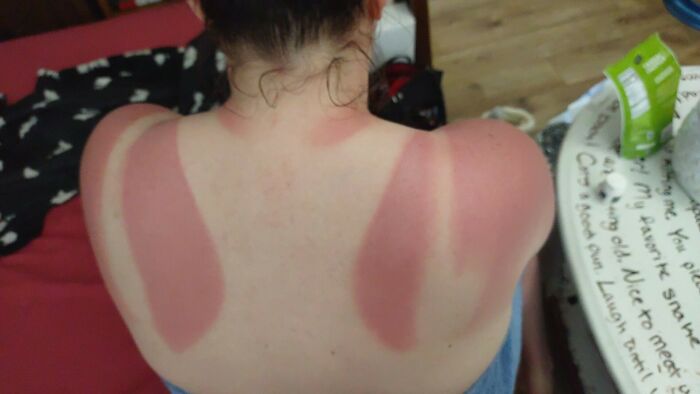 Two Days After I Got Sunburned