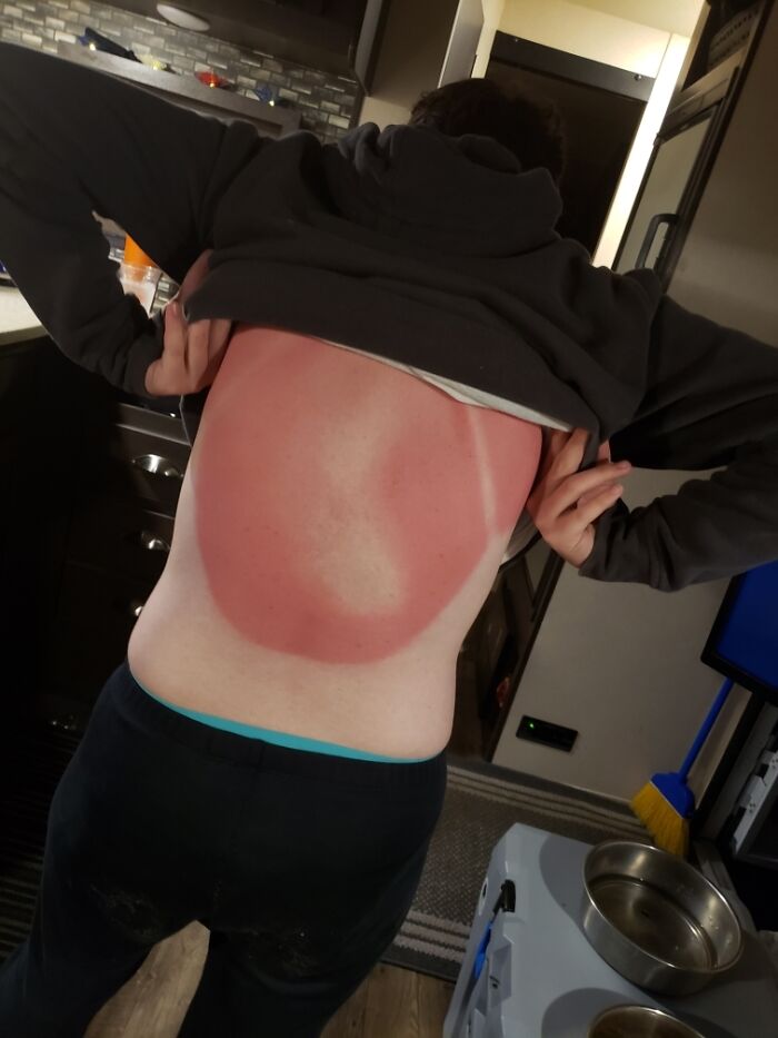 My Worst Sunburn Ever
