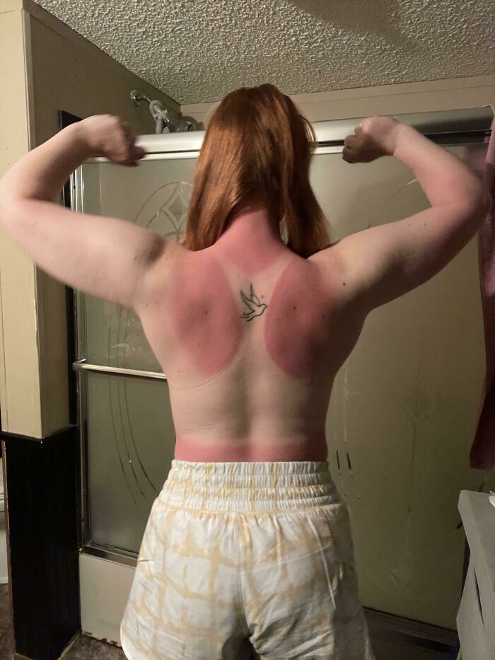 It Was Cloudy And The UV Index Was 4… Didn’t Even Occur To Me To Apply Sunscreen