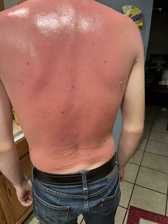 “I’m Not Gonna Be In The Pool That Long, I Won’t Need Sunscreen”