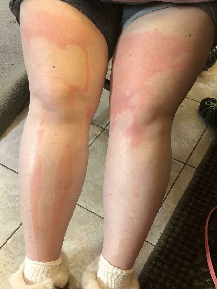 Missed A Few Spots With The Sunscreen Stick