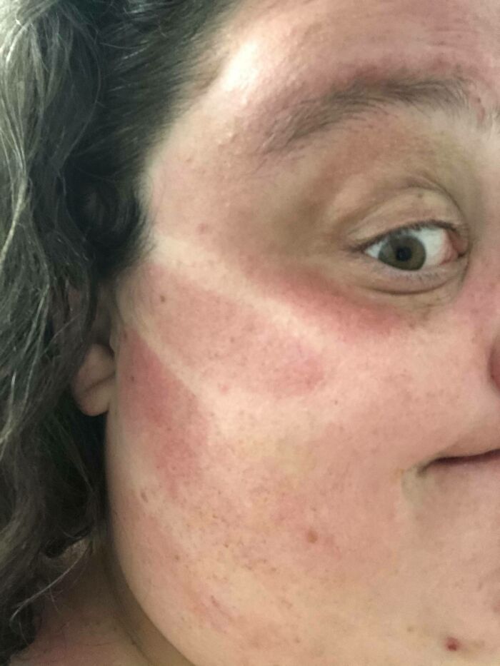 Had To Unexpectedly Sit Outside For Parent Information Pick Up And Didn’t Put On Sunscreen