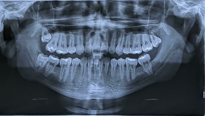 There's A Tooth In My Chin