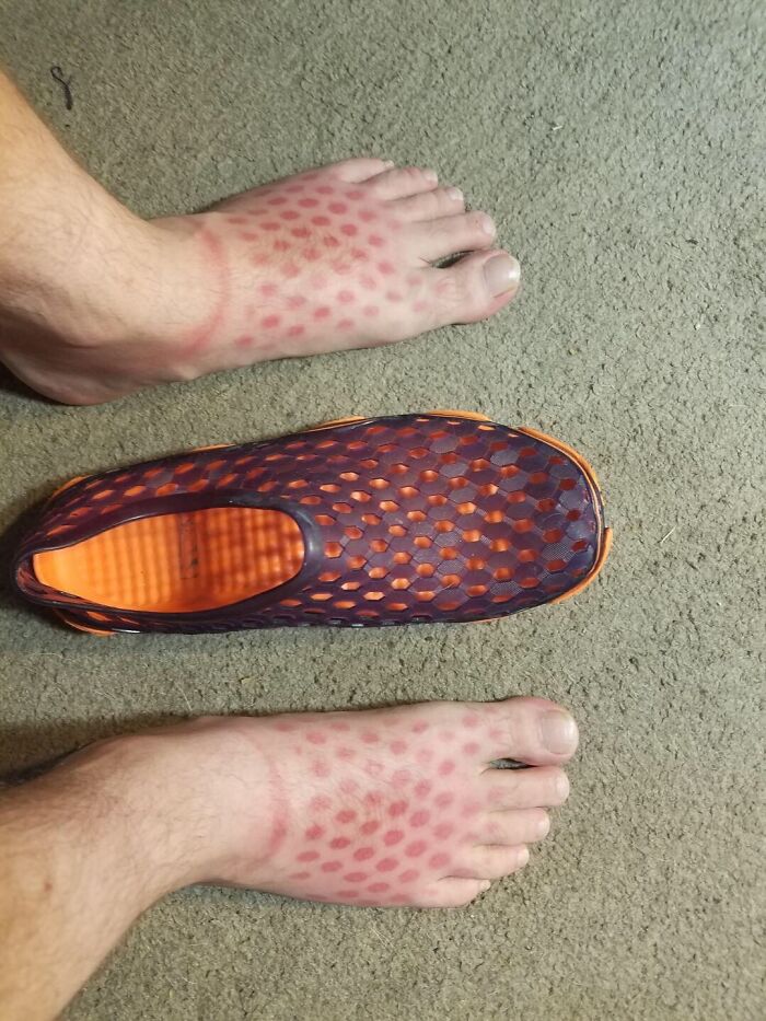 Tan Lines Are Hot, Right? When You Forget To Put Sunscreen On Your Feet