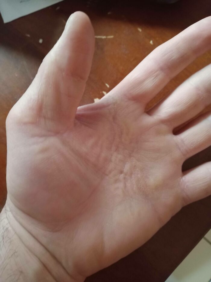 Apparently My Thumb May Be An Absolute Unit?