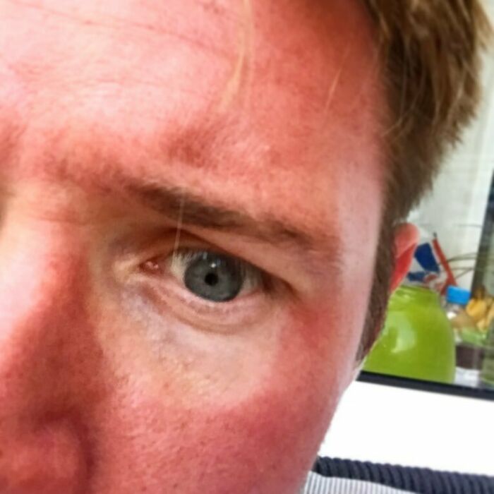 I Dozed With My Sunglasses On And This Happened