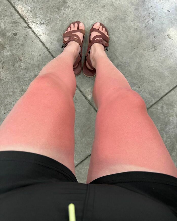 Got A Little Sunburnt On The Kayak Yesterday