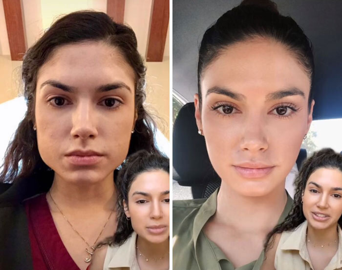 "This Is Why Everyone Looks The Same": People Slam This Nurse Injector For Giving Natalia Dyer A Face Transformation