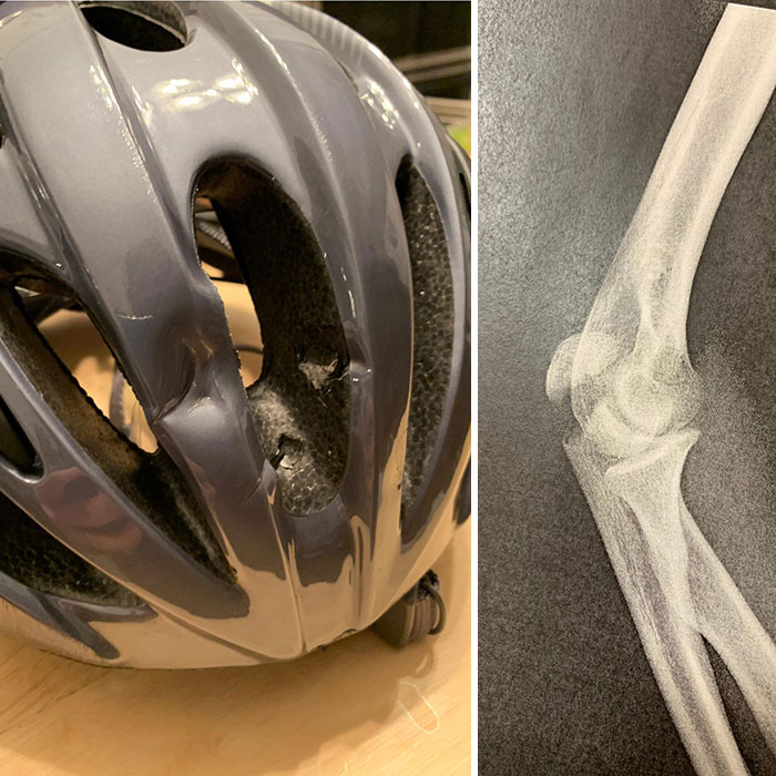 Con el codo roto, ¡pero el casco me salvó la cabeza! Agradezco haber llevado uno