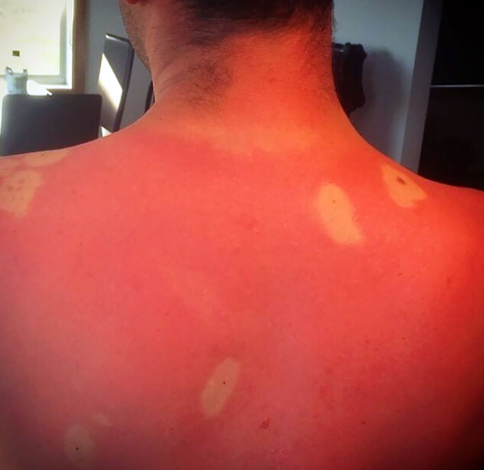 I Probably Should Have Covered His Whole Back In Sunscreen And Not Just His Moles