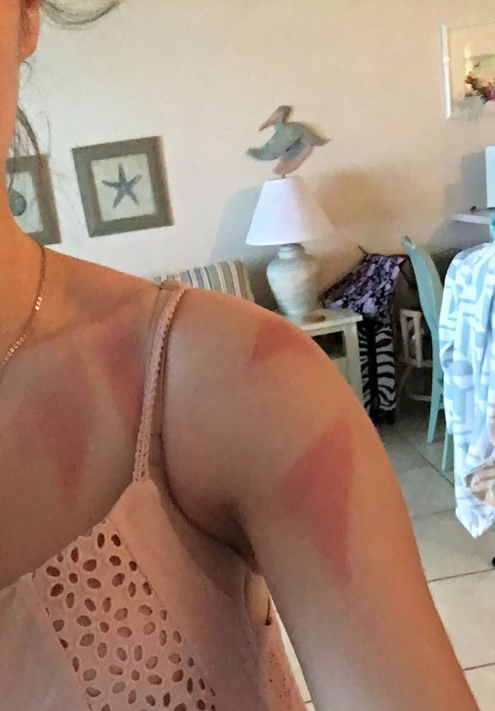 When You Use Spray Sunscreen And Forget To Rub It In So It Leaves Whack Tan Lines