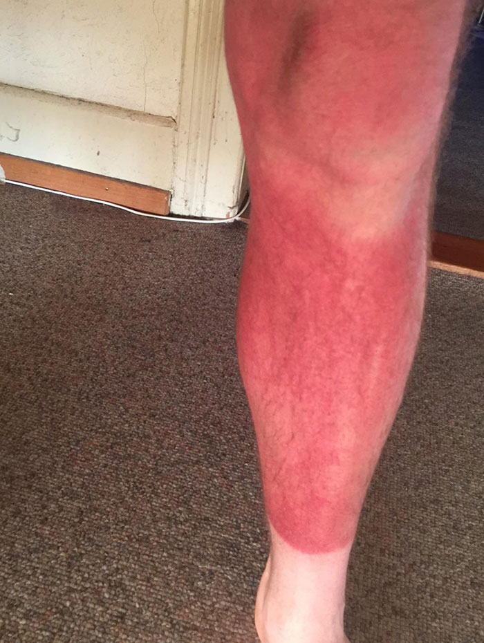 Painted Roof For 6 Hours With Only 1 Leg In The Sun Without Sunscreen