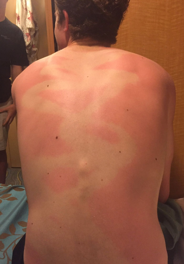 PSA: Always Rub In Spray Sunscreen