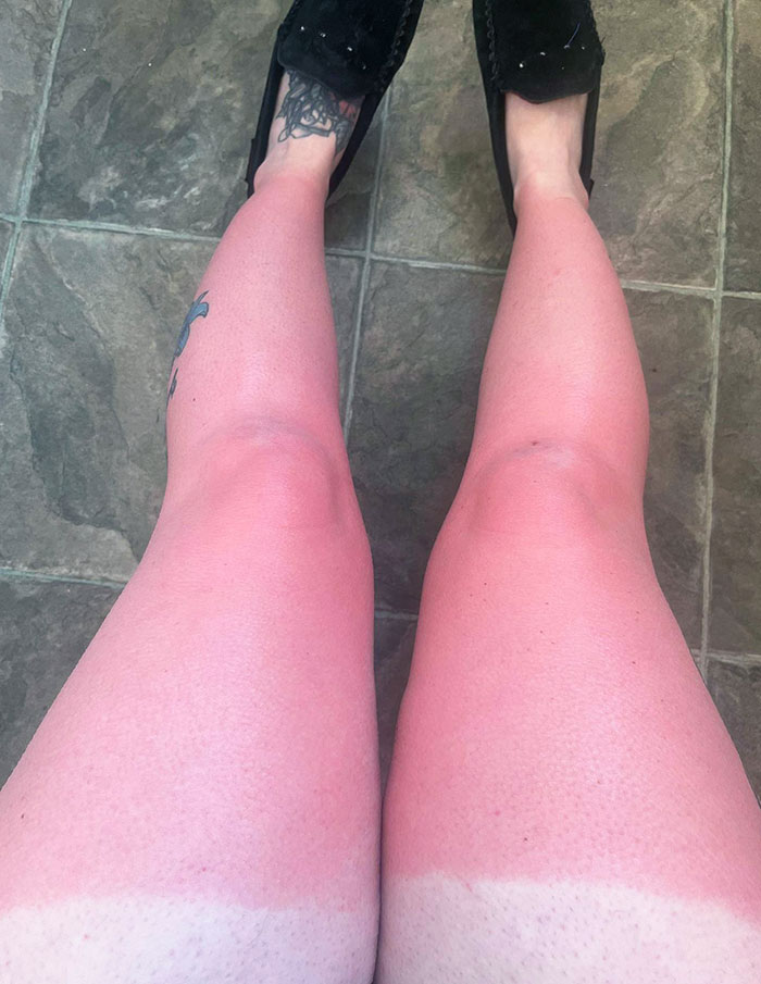 A Day Of Softball. Sunscreen Didn’t Help, And I Learned My Lesson