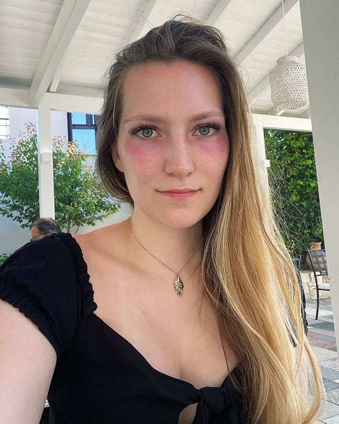 I Got Sunburned On My Face And Shoulders