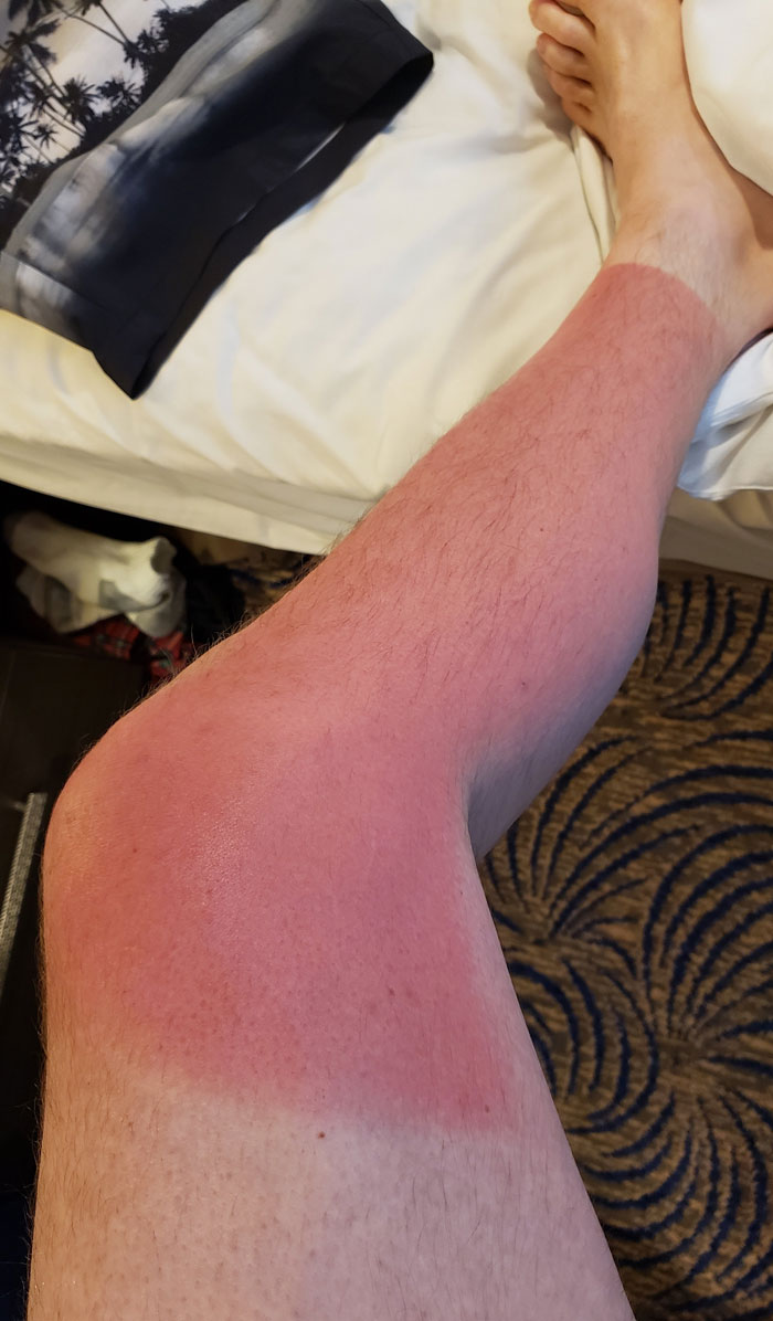 I Forgot To Apply Sunscreen