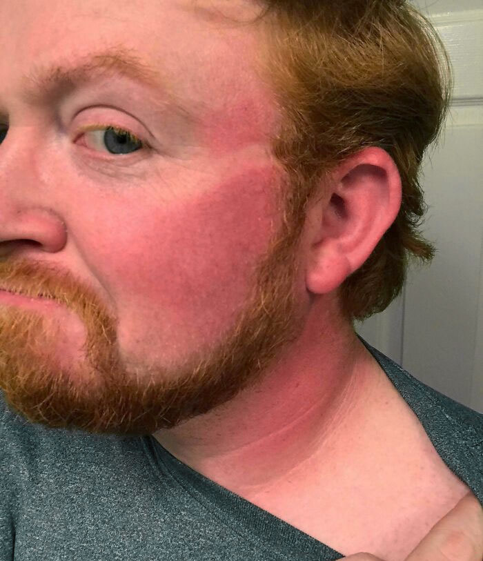 Leave It To A Ginger To Get Sunburnt Fishing Off The Bank When It's In The High 50's