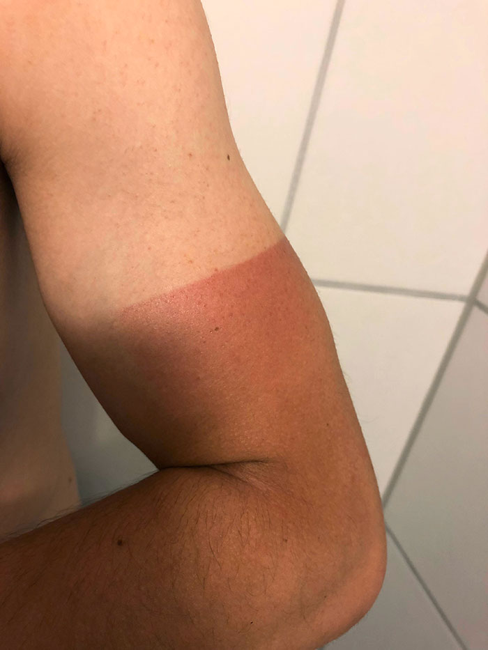 I Guess Sunscreen Would Have Been The Better Option. This Tan Line Will Make All The Dentists Fall Off Their Cervelos