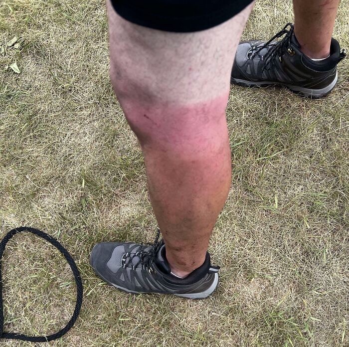 I Bought Some New Shorts That Are Shorter Than My Other Shorts For Work. Now My Leg Looks Like Neapolitan Ice Cream