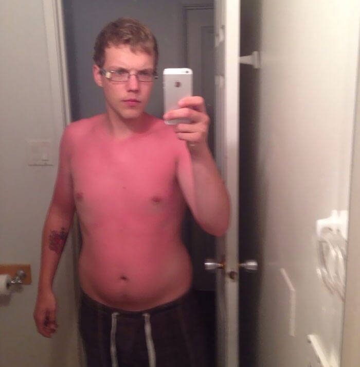 Drank 10 Beers In The Sun Yesterday, Thank God I Had A Hat