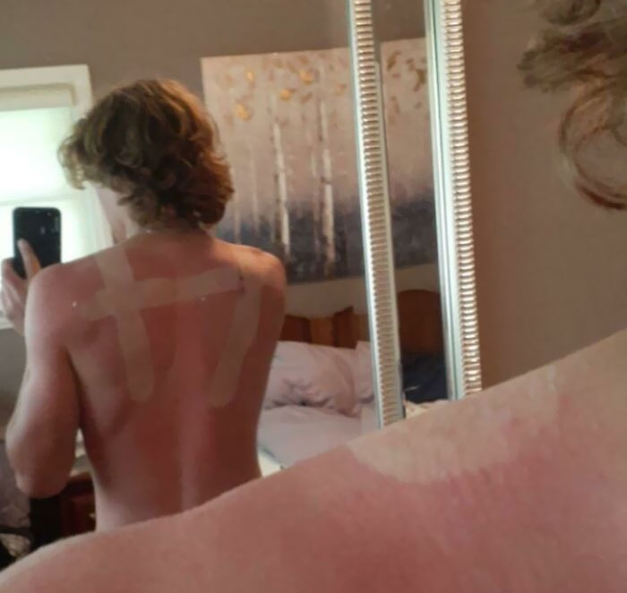 Went To The Beach Today. Missed Some Spots With The Ol' Sunscreen