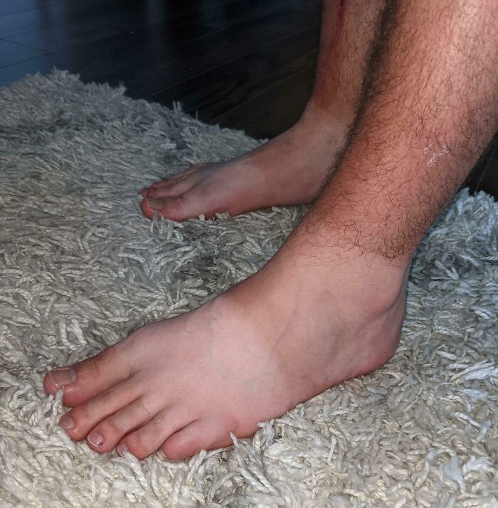 We Call This The Neapolitan Sun Tan. Courtesy Of My Husband's Foot