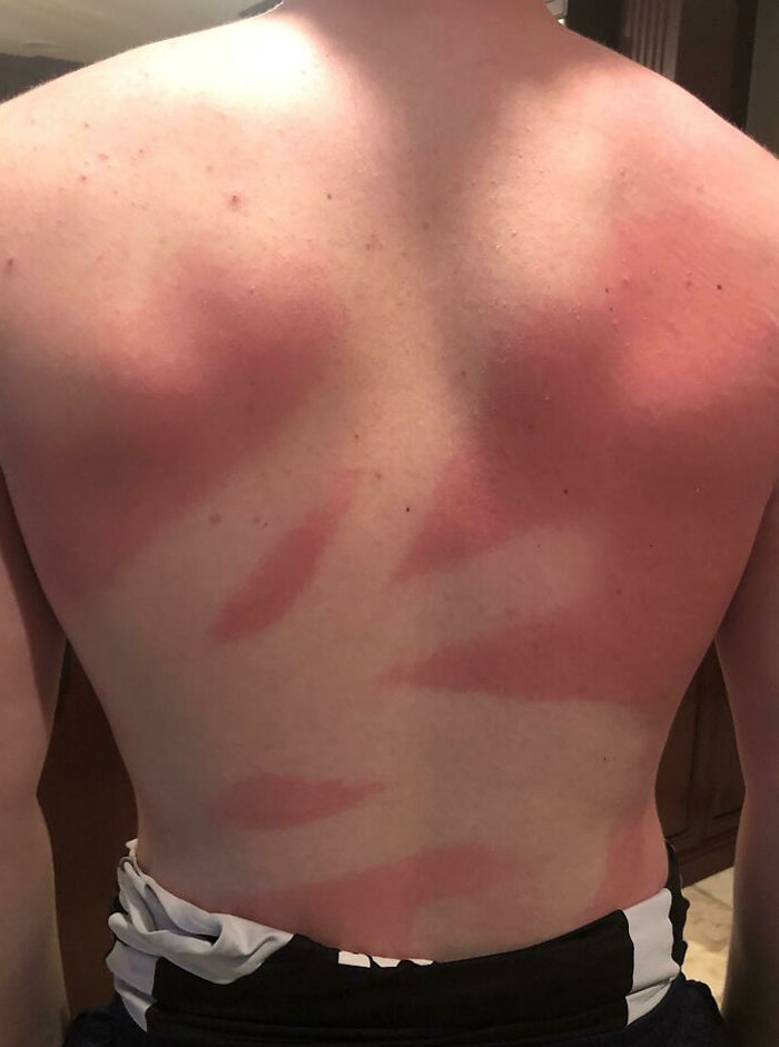 Asked My Friend To Spray Sunscreen On My Back... Not The Most Even Coat