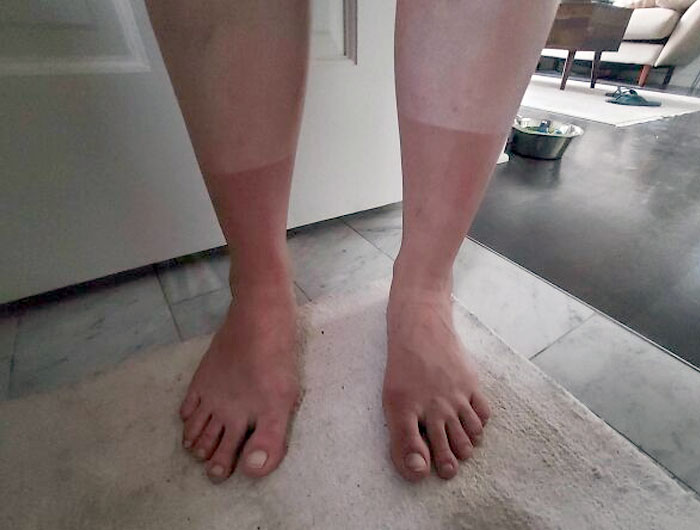 Sunburn Socks